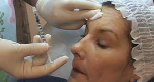 Rejuvenare faciala – Tratamentul ridurilor cu toxina botulinica